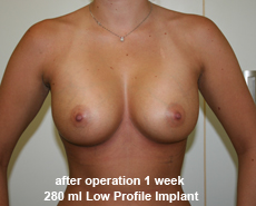 plastic-surgery-breast-augmentation